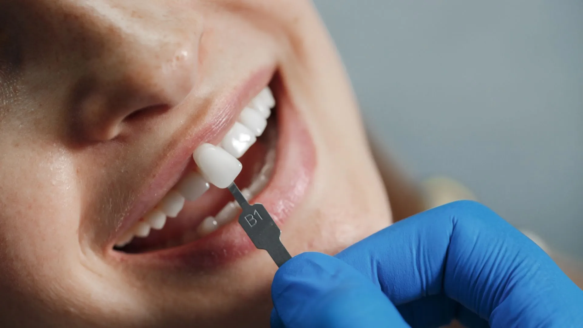 How Veneers Transform Your Overall Facial Profile
