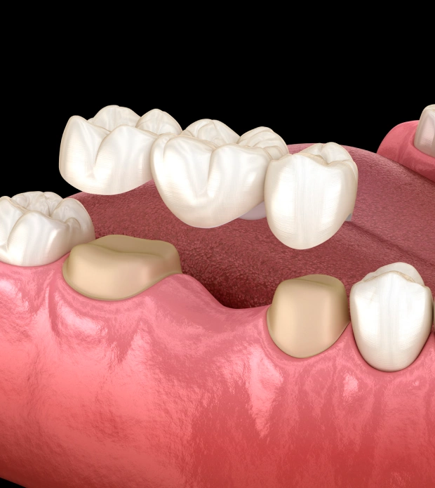 Dental Bridges