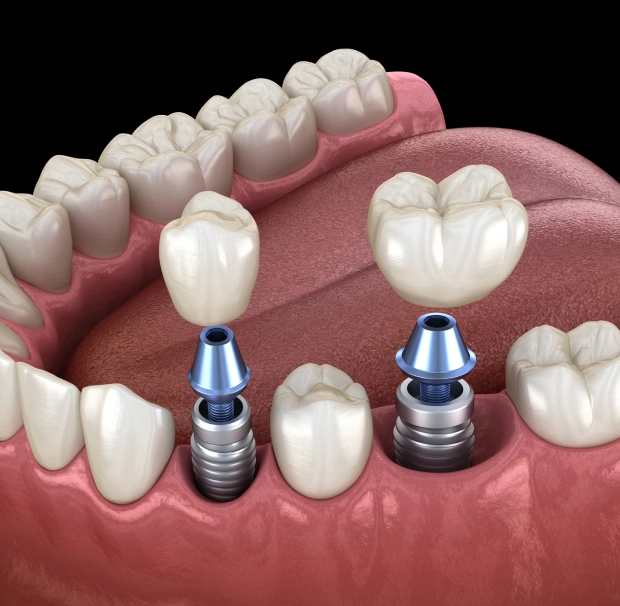Dental Implants