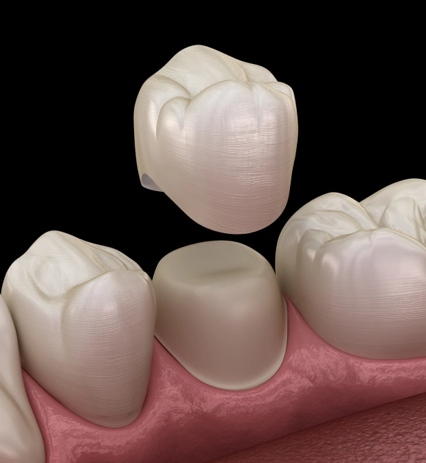 Dental Crowns