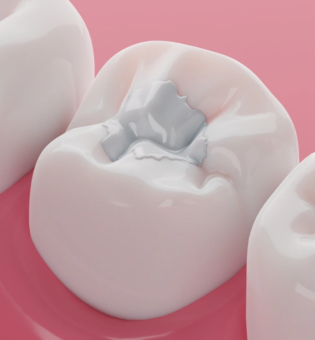 Dental Fillings